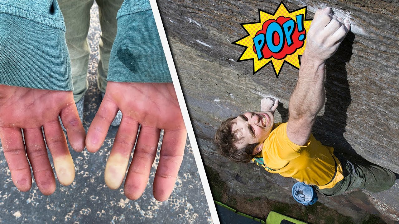 recovering from bouldering injuries